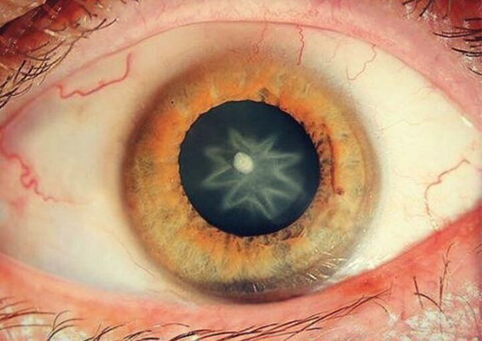 Star in the eye