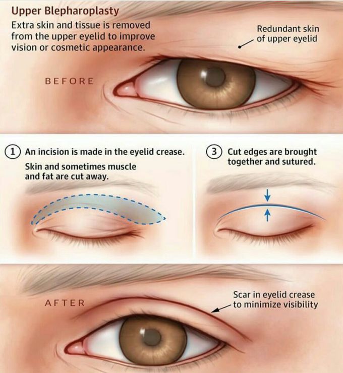 Blepheroplasty