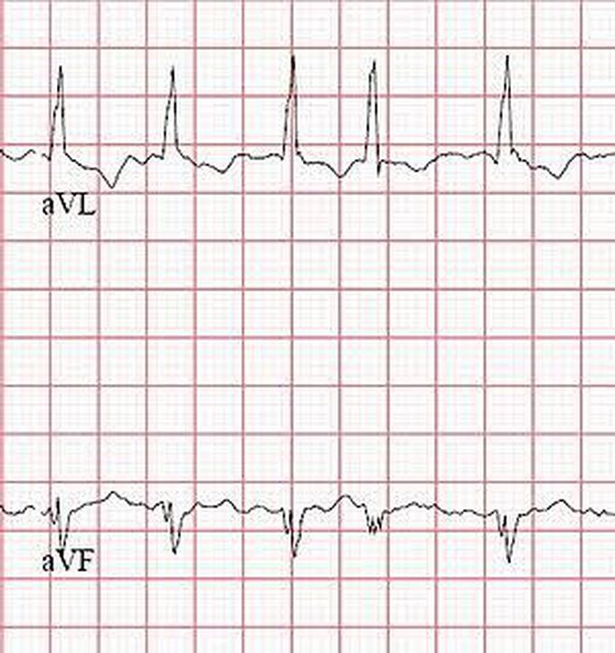 Atrial fibrillation