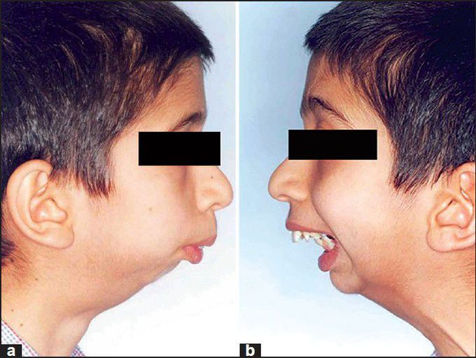 Symptoms of Tmj ankylosis