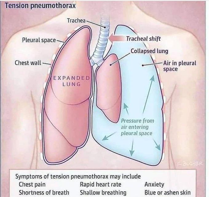 Tension Pneumothorax