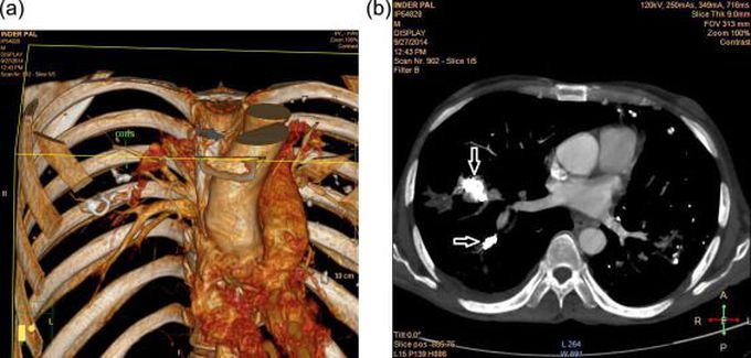 Rasmussen’s Aneurysm