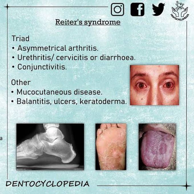 Causes of reiters syndrome