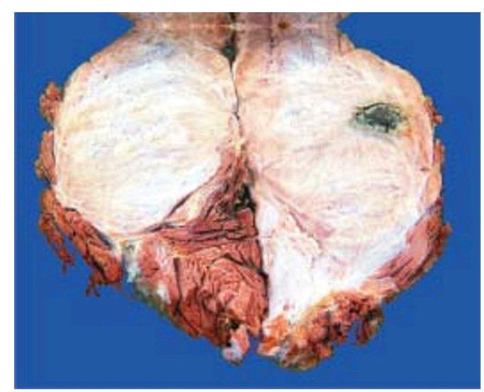 Malignant fibrous histiocytoma.