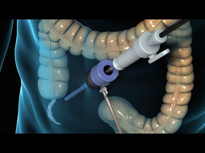 Laparoscopic Appendectomy: Animation