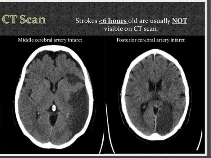 Ischemic stroke