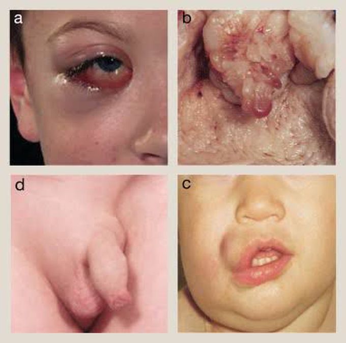 Rhabdomyosarcoma