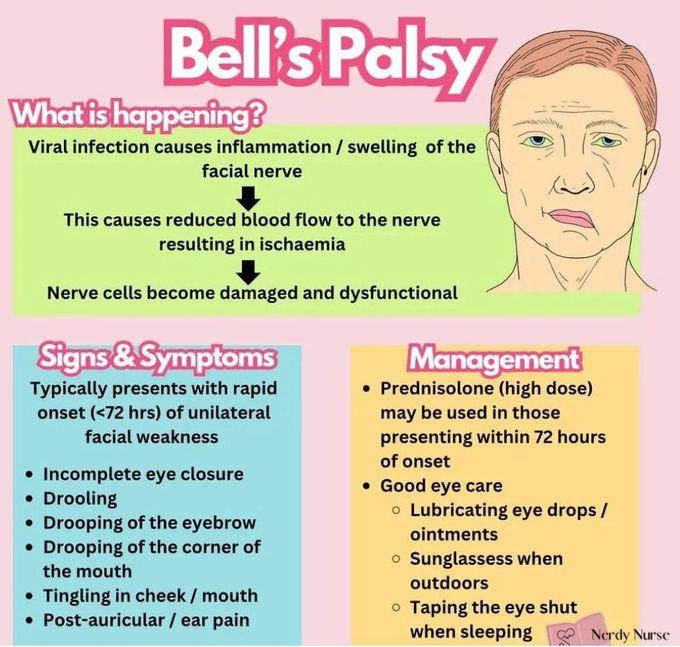 Bell's Palsy