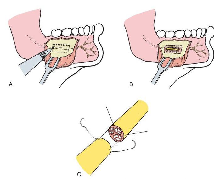 Microneurosurgery