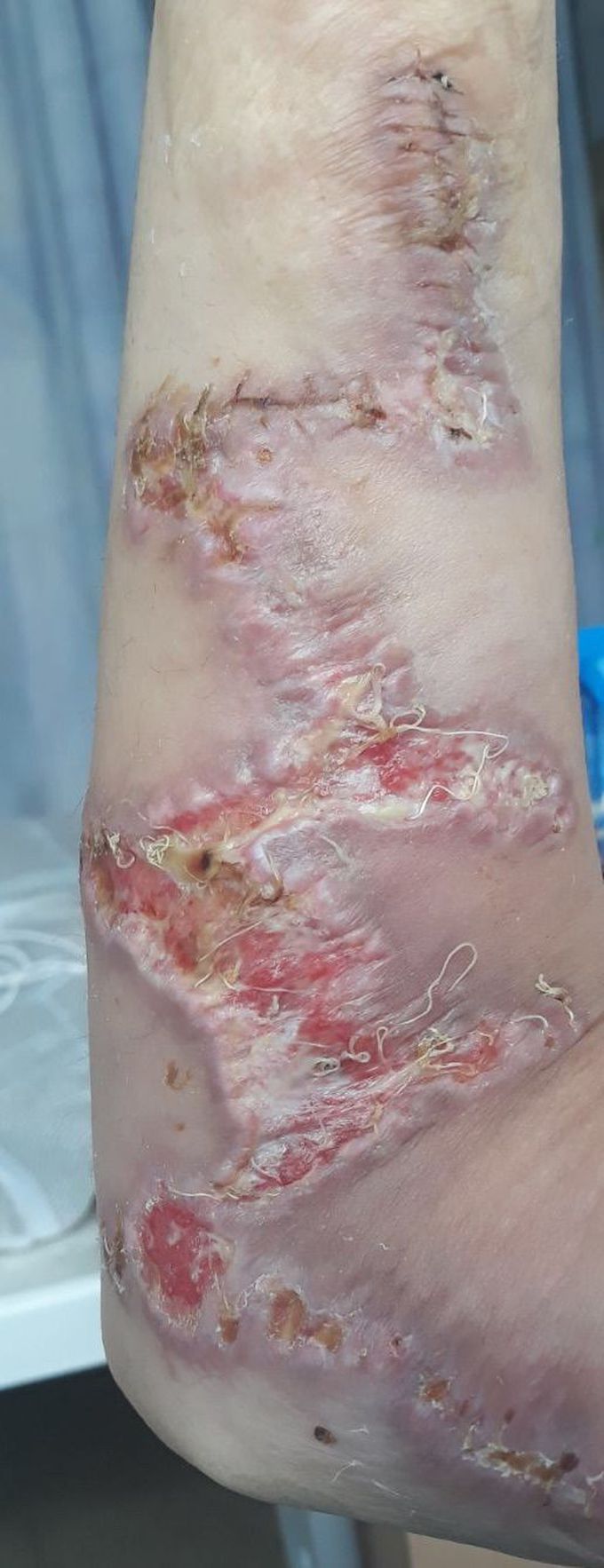 After a plasticsurgery on the hand in one week the operation started swelling with headaches and dizziness and fever 🤒,what is your diagnosis??and treatment please!