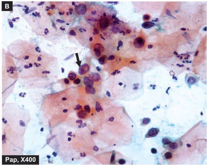 High grade Squamous intraepithelial lesions (SIL).