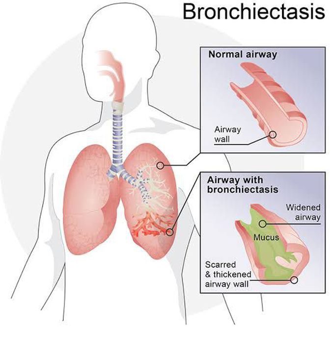 Broncheictasis Symptoms
