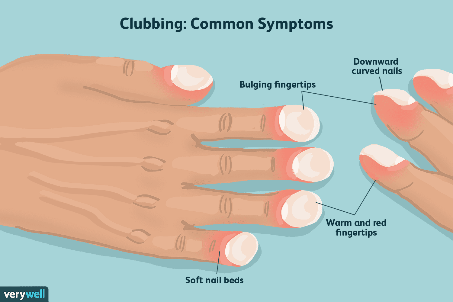 What Does It Mean If Your Fingertips Are Numb