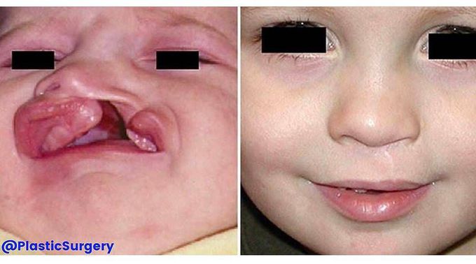 Primary Cheiloplasty using the Technique of Millard - Semantic Scholar