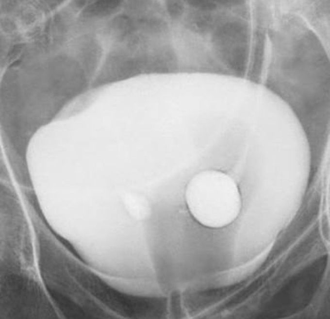 Bladder