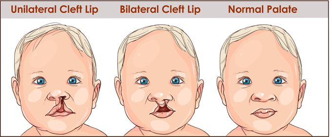 Cleft lip with cleft palate