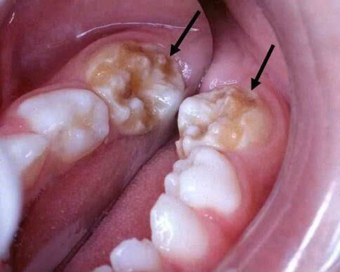 Enamel hypoplasia