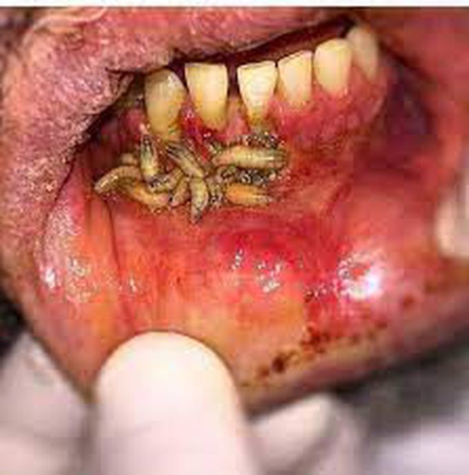 Causes of oral myiasis