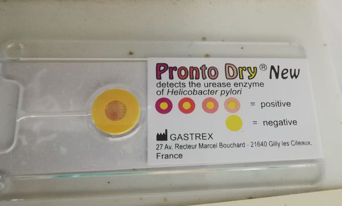 Helicobacter pylori urease test was done during the OGD endoscopy to findout the etiology for 3 days history of melaena