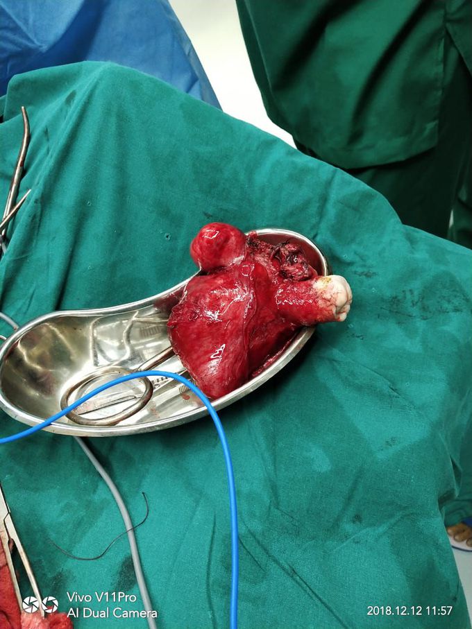 Fibroid uterus