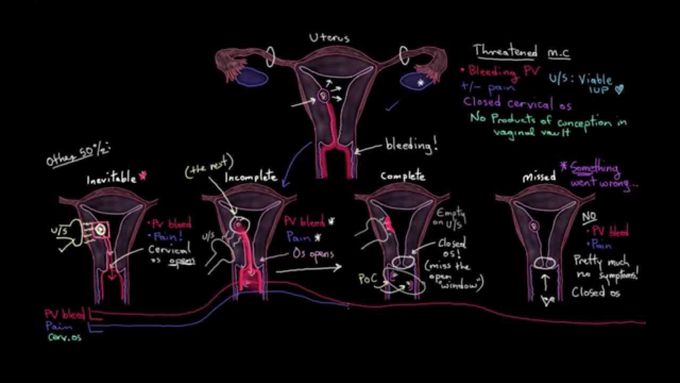 Types of miscarriage