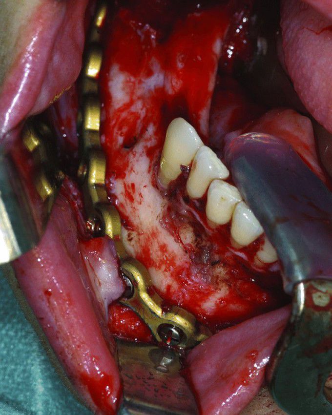 Intraoral incision and fixation