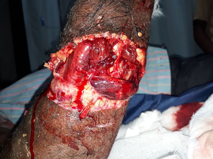 Injured rt forearm with radius ulna #
