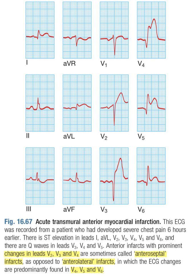 EKG Image of Acute Transmural Anterior MI