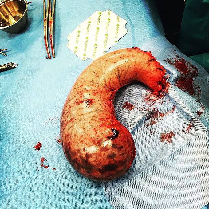 Here's a resected stomach after sleeve gastrectomy of about 80% of the stomach
