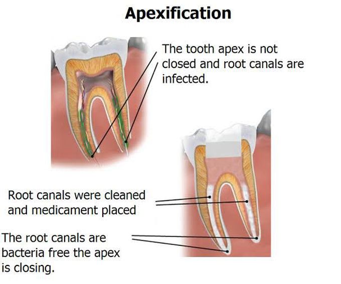 Apexification