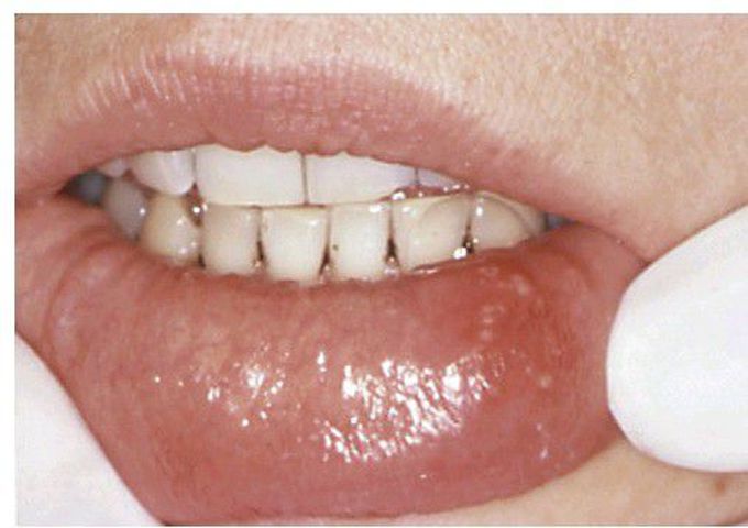 Herpetiform aphthous ulcer