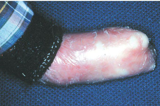 Epidermolysis Bullosa.