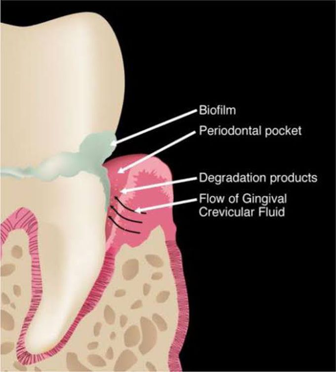 Gingival Crevicular Fluid