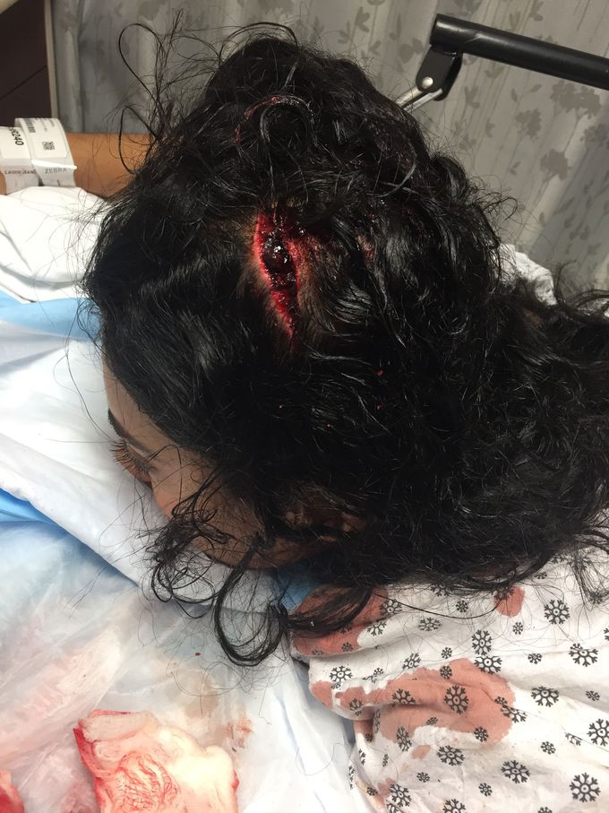 Laceration
