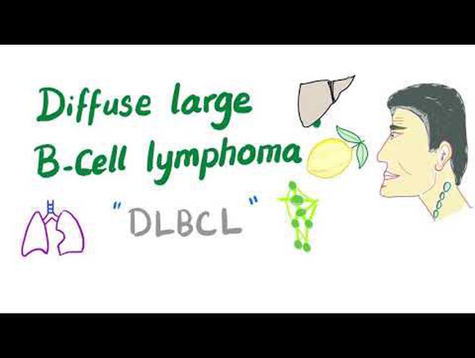 Pathology of Diffuse Large B-Cell Lymphoma (DLBCL)
