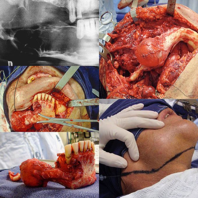 ⚠️Discretion⚠️ 💀🔪 Multicystic Ameloblastoma