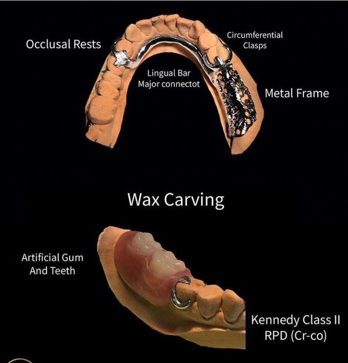 Lower Metal Partial Dentures