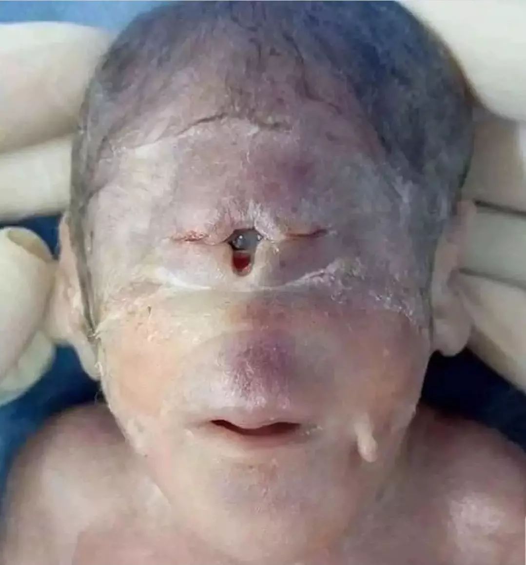 holoprosencephaly adult