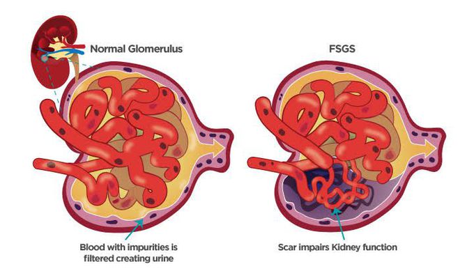 Glomerulosclerosis