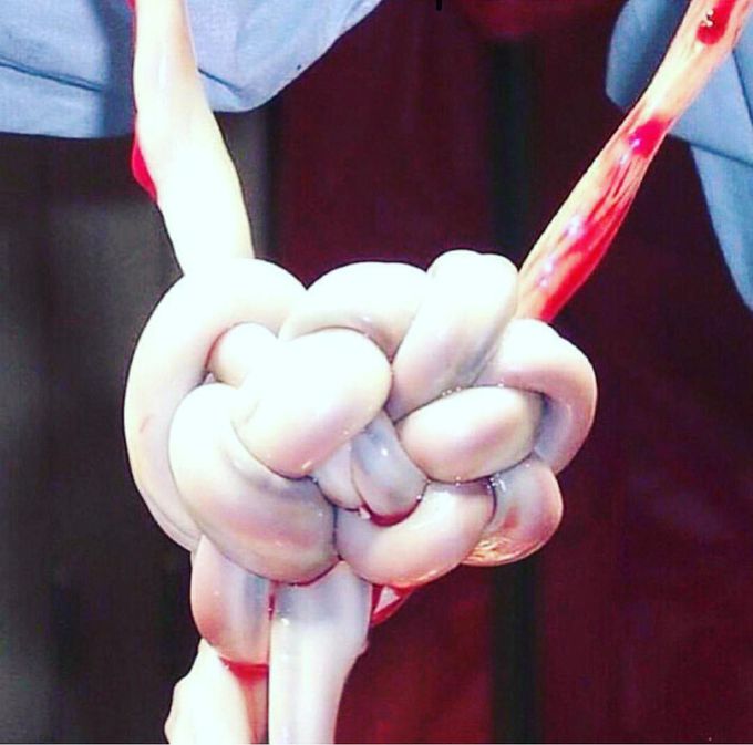 Umbilical cord compression 