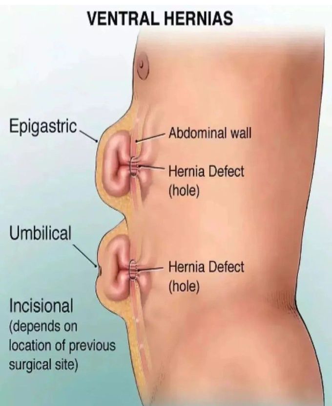 Ventral Hernias