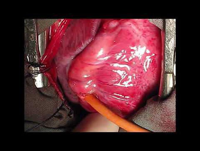 Congenital Right Coronary Artery to Right Ventricle Fistula Ligation Without Cardiopulmonary Bypass
