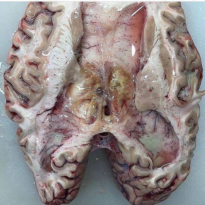 BACTERIAL MENINGITIS