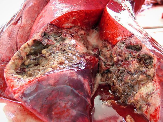 Tuberculosis affected lung!