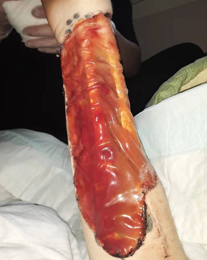 Forearm covered with Integra after full thickness skin harvesting to reconstruct the defect of the lower body