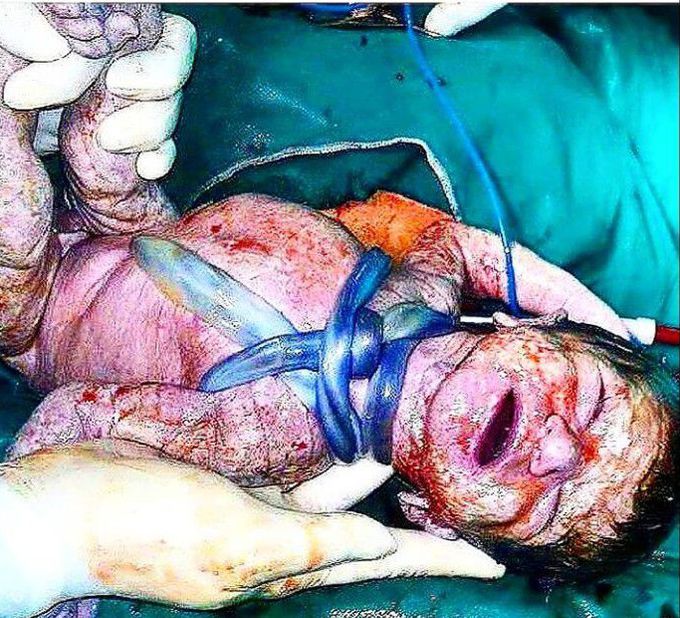 Nuchal cord