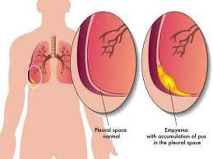 Treatment for empyema