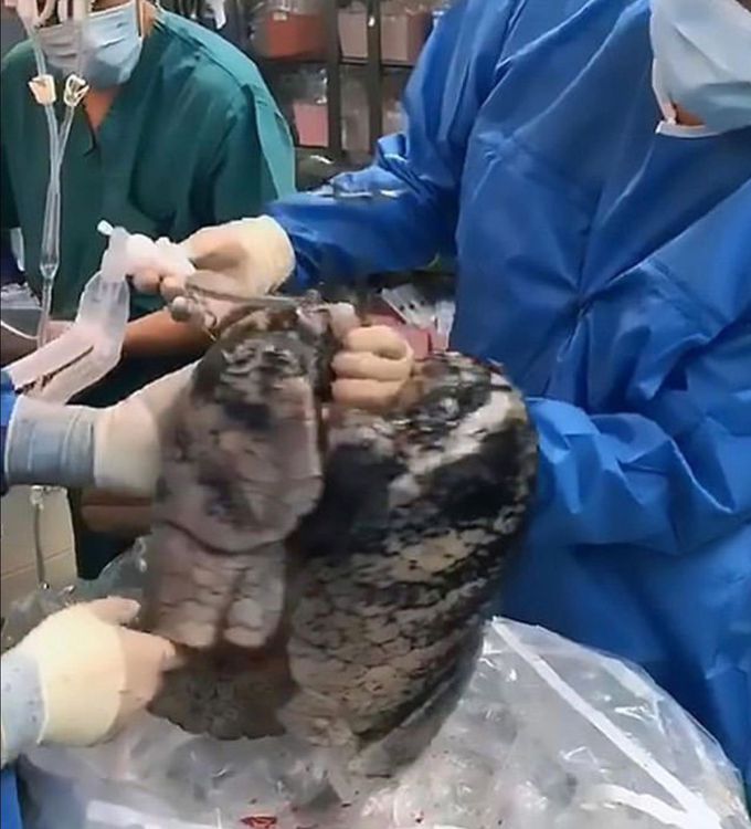 Lung of man after 30 year smoking 😰