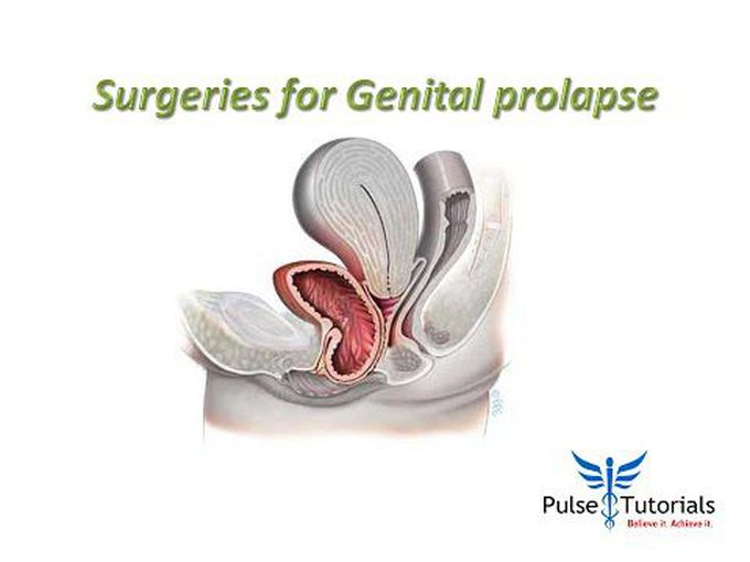 Surgical Management for UV Prolapse