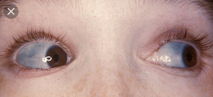 Osteogenesis imperfecta